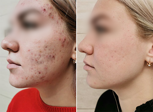 Akneentzündete Haut – BEMER-Lichttherapie