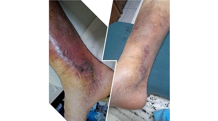 50 éves férfi érszűkülettel – 2 hét BEMER terápia után!