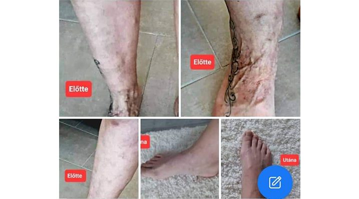 Visszérproblémák? Egy valós tapasztalat a BEMER terápiáról!